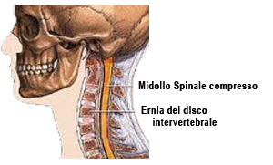 Ernia cervicale Cervicalgia