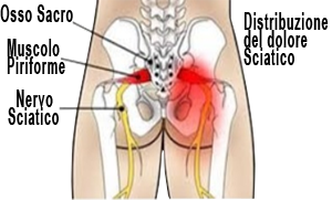 Sciatalgia Sciatica