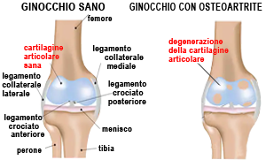 la cura per Artrosi al ginocchio Curare la gonoartrosi con l'ozonoterapia